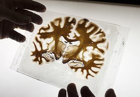 Photo Vedci našli spôsob ako dopraviť liečivá do pacientovho mozgu. Pomocou ultrazvuku