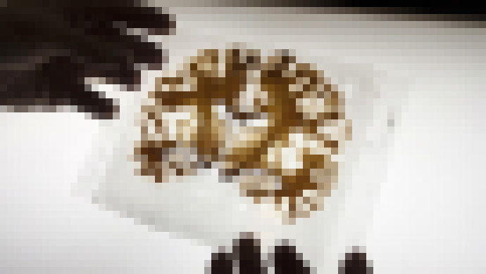 Photo Vedci našli spôsob ako dopraviť liečivá do pacientovho mozgu. Pomocou ultrazvuku