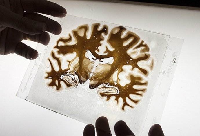 Photo Vedci našli spôsob, ako dopraviť liečivá do pacientovho mozgu. Pomocou ultrazvuku