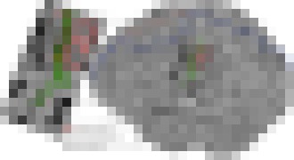 Photo Mozgový implantát umožní prvýkrát pomocou myšlienok hýbať prstami na protéze