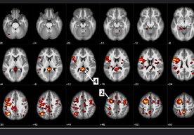 Photo IBM a Albertská univerzita využili algoritmy strojového učenia pri odhaľovaní symptómov schizofrénie