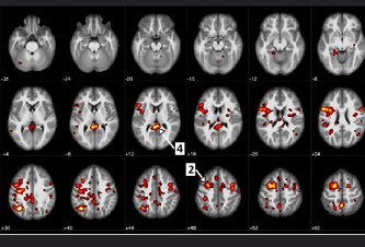Photo IBM a Albertská univerzita využili algoritmy strojového učenia pri odhaľovaní symptómov schizofrénie