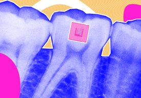 Photo Zubný implantát vie rozpoznať, čo ste jedli, pili alebo fajčili