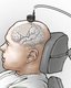Photo Mozgový implantát mení myšlienky na slová, aby ochrnutý človek mohol zase „hovoriť“