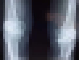 Photo Nanomateriál zregeneroval chrupavku v kolene