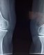 Photo Nanomateriál zregeneroval chrupavku v kolene
