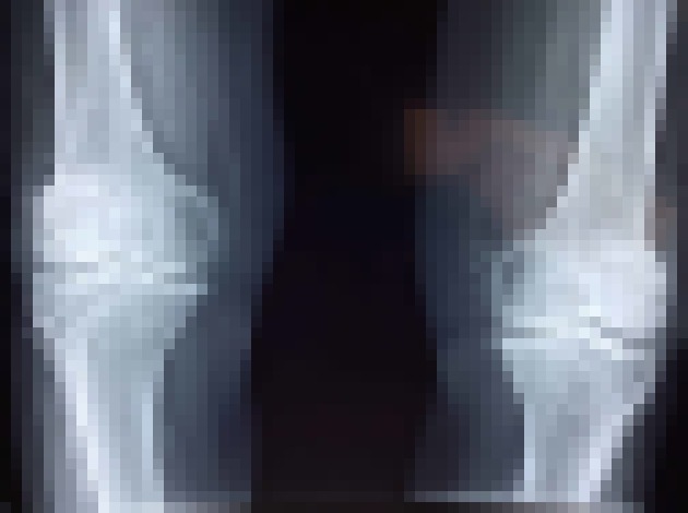 Photo Nanomateriál zregeneroval chrupavku v kolene