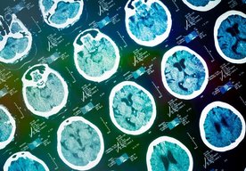 Photo Nový liek môže napraviť poškodenie mozgu spôsobené Alzheimerovou chorobou