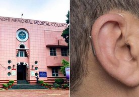 Photo Študent podvádzal na skúške pomocou bluetoothového zariadenia chirurgicky implantovaného v uchu