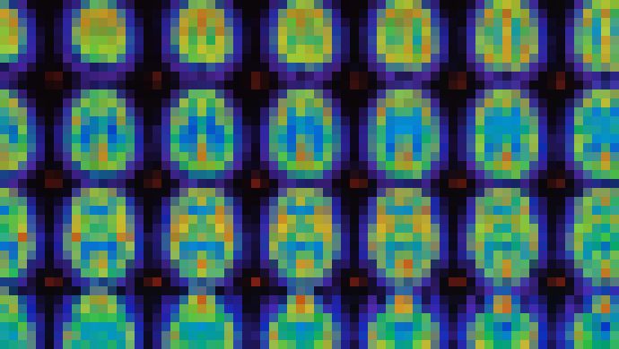 Photo Prvá génová terapia na liečbu Alzheimera