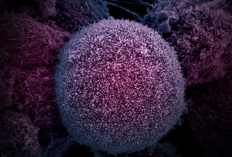 Photo Nová revolučná liečba rakoviny využíva na ničenie nádorov svetlo