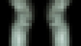 Photo Piezoelektrický hydrogél prináša prelomovú liečbu pacientom s osteoartrózou 