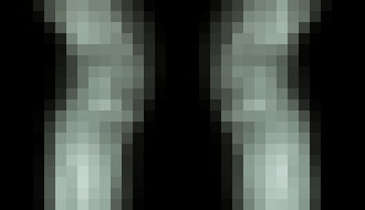 Photo Piezoelektrický hydrogél prináša prelomovú liečbu pacientom s osteoartrózou 