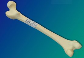 Photo Bioaktívny kompozit pomôže na výplň a hojenie zlomených kostí