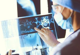 Photo Prielom v liečbe rakoviny: Mozgový nádor za päť dní takmer zmizol 