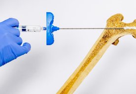 Photo Injekčne podávaný hydrogél môže posilniť krehké kosti