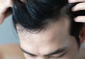 Photo Sľubný prelom v liečbe plešatosti a obnove rastu vlasov