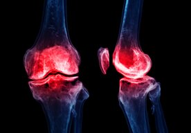 Photo Revolučný hydrogél dokáže zastaviť artrózu a obnoviť chrupavku