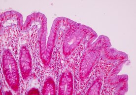 Photo Vedci preprogramovali salmonelu a vypustili ju na rakovinové nádory s prekvapivým výsledkom