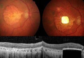 Photo Inovatívny elektronický implantát vracia videnie pacientom s degeneráciou makuly