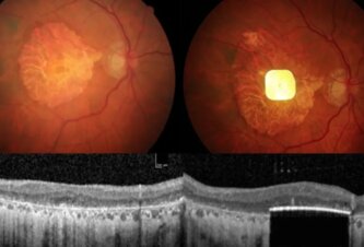 Photo Inovatívny elektronický implantát vracia videnie pacientom s degeneráciou makuly