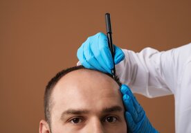 Photo Revolučná technológia NeoGraft sľubuje koniec plešatosti bez jaziev a bolesti 