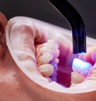 Photo Prelomový gél dokáže opraviť zubnú sklovinu a čoskoro sa môže dostať aj na trh