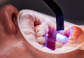 Photo Prelomový gél dokáže opraviť zubnú sklovinu a čoskoro sa môže dostať aj na trh