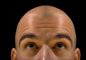 Photo Prekvapivý objav v liečbe plešatosti pomocou cukru  