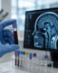 Photo Nový test dokáže predpovedať Alzheimera až 20 rokov pred príznakmi